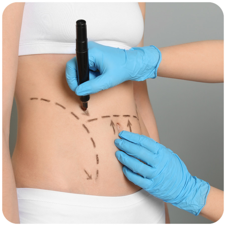 Abdominoplastía